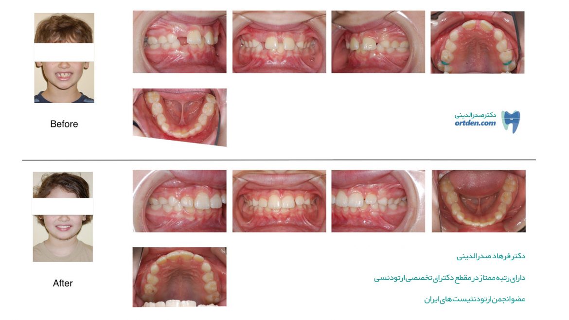 درمان ناهنجاری فاصله بین دندانها با ارتودنسی