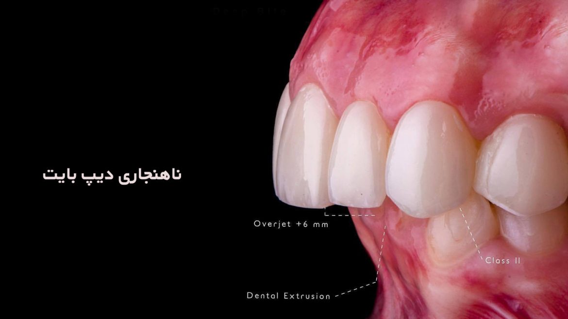 ناهنجاری دیپ بایت